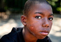 Ka'Nard Allen, 10, continues to heal from his bullet wound on the cheek Sunday. | Photo Kathleen Flynn, Nola.com